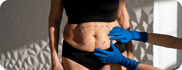 Abdominoplastia