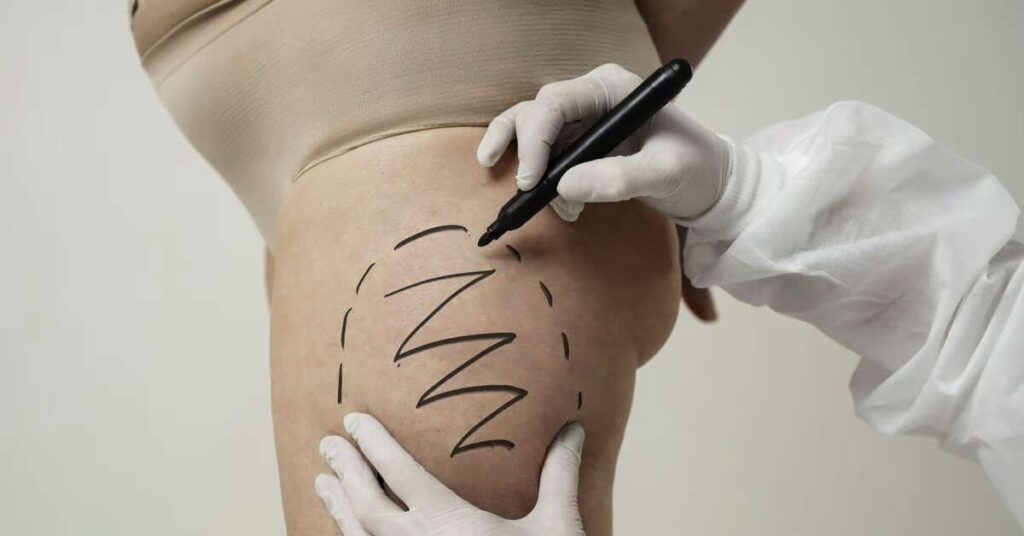 Lifting de Coxas: tipos e técnicas de Cruroplastia Pós-bariátrica 1 Lifting de Coxas - Tipos e Técnicas de Cruroplastia Pós Bariátrica