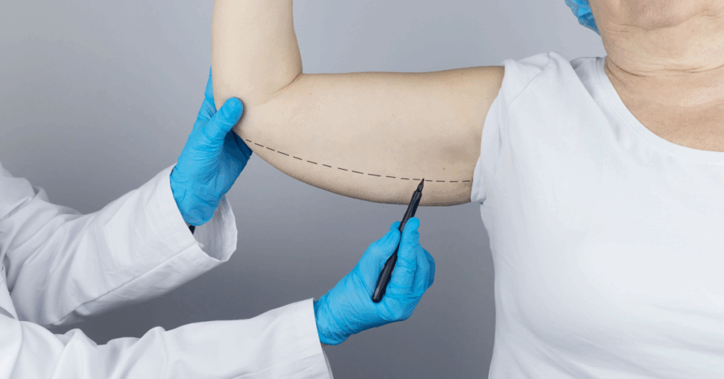 Perguntas a Fazer ao seu Cirurgião Antes da Braquioplastia Pós bariátrica 1 Perguntas a Fazer ao seu Cirurgiao Antes da Braquioplastia Pos bariatrica