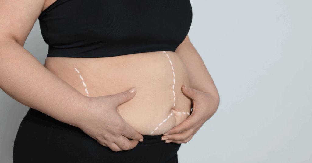 Planejando sua Abdominoplastia Pós-bariátrica: Passo a Passo do Processo Cirúrgico 1 Planejando sua Abdominoplastia Pos-bariatrica_ Passo a Passo do Processo Cirurgico