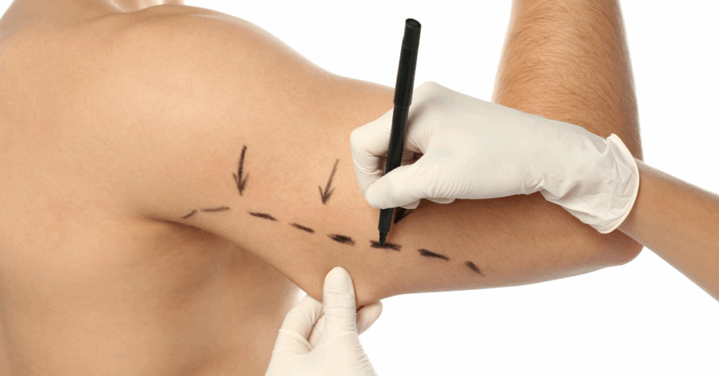 Consulta Detalhada Sobre Braquioplastia Pós-Bariátrica: Conheça o Dr. Giancarlo Dall´Olio 1 Consulta Detalhada sobre Braquioplastia Pós bariátrica - Conheça o Dr Giancarlo DallOlio