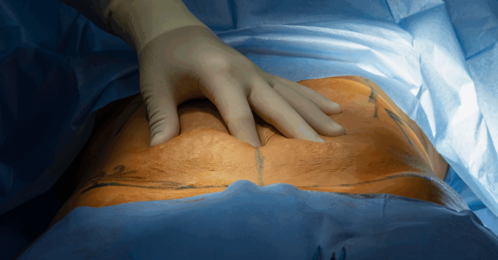 Cuidados Específicos no Pós-Operatório de Abdominoplastia Pós-Bariátrica 1 Cuidados Específicos no Pós-operatório de Abdominoplastia Pós bariátrica