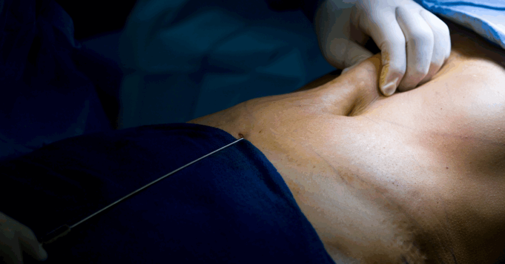 Qualidade e Segurança: Escolha um Médico Cirurgião Plástico em São Paulo para Realizar sua Lipoaspiração Pós-Bariátrica 1 Qualidade e Segurança - Escolha um Medico Cirurgião Plástico em São Paulo para realizar sua Lipoaspiração Pós bariátrica