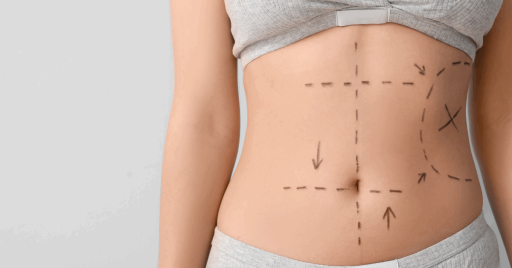 Lipoaspiração Após Cirurgia Bariátrica: Conselhos Especializados do Dr Giancarlo Dall´Olio 1 Lipoaspiração Após Cirurgia Bariátrica Conselhos Especializados do Dr Giancarlo Dall´Olio