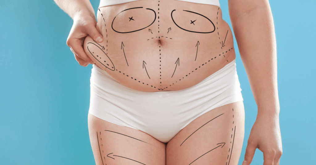 Perguntas Comuns Respondidas sobre Lipoaspiração Pós-Bariátrica 1 Perguntas Comuns Respondidas sobre Lipoaspiração Pós Bariátrica