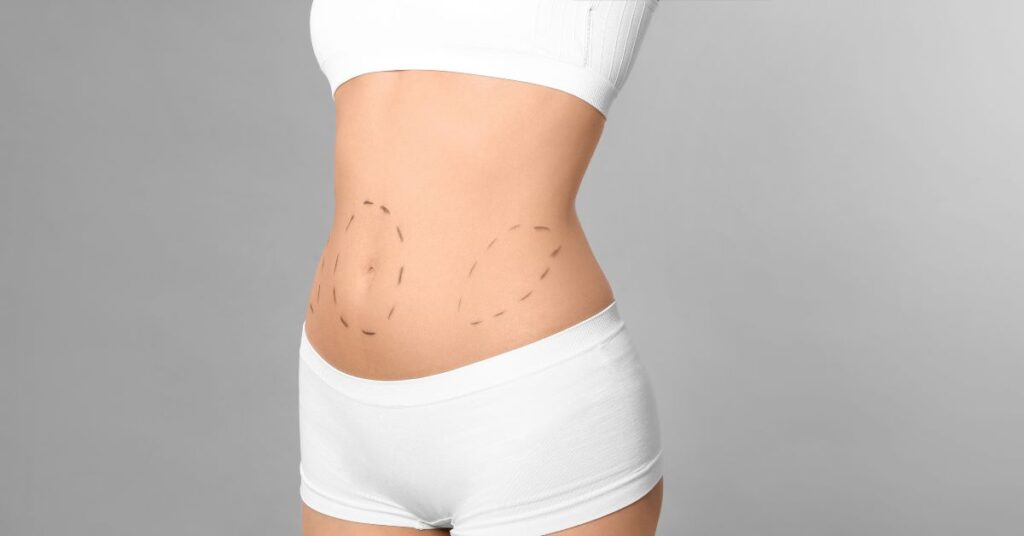 Perguntas comuns respondidas sobre lipoaspiração pós-bariátrica 2 2 2 Perguntas comuns respondidas sobre lipoaspiracao pos bariatrica