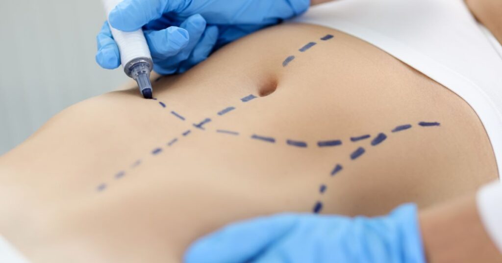 Antes de decidir pela abdominoplastia pós-bariátrica: o que você precisa considerar 2 3 2 Antes de decidir pela abdominoplastia pos bariatrica o que voce precisa considerar