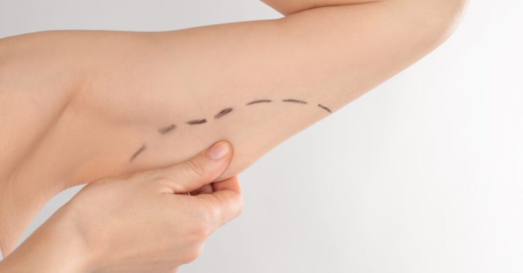 Agendando sua braquioplastia pós-bariátrica com o Dr. Giancarlo Dall´Olio: passos a seguir 2 4 2 Agendando sua braquioplastia pos bariatrica com o Dr Giancarlo Dall´Olio passos a seguir