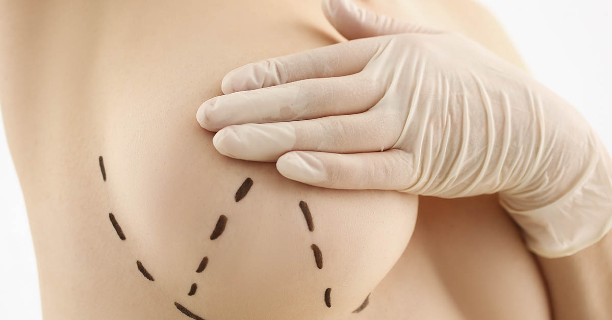 Preparação para cirurgia de mamoplastia pós-bariátrica: checklist completo 2 Preparação para cirurgia de mamoplastia pós-bariátrica: checklist completo