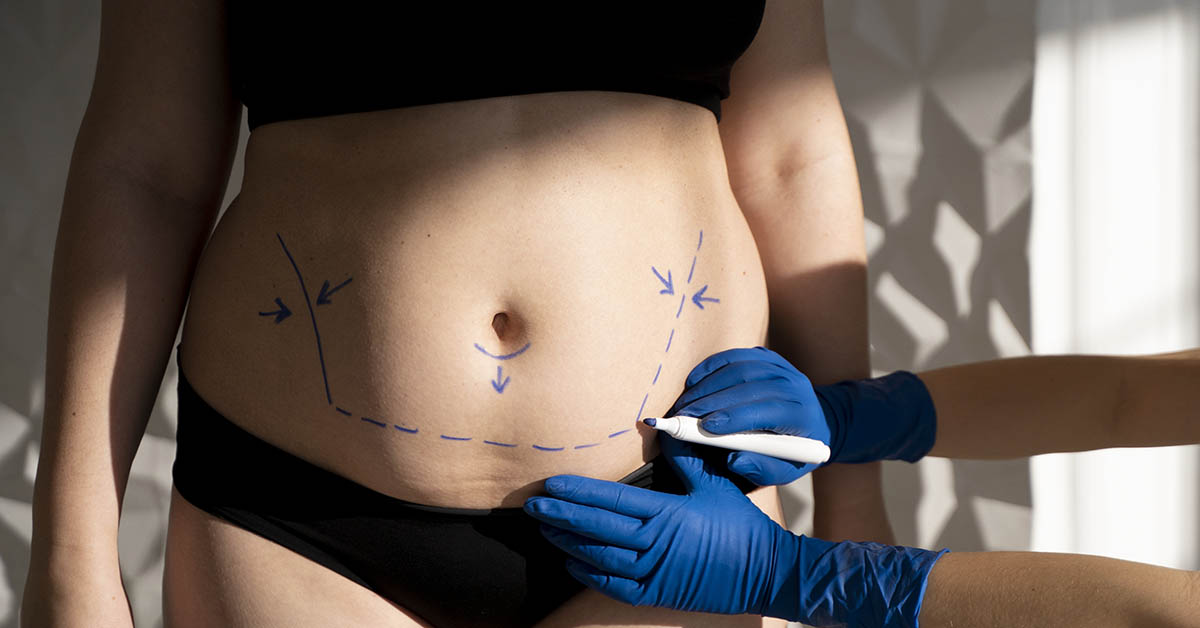 Procedimentos complementares à lipoaspiração pós-bariátrica para resultados ótimos 2 Procedimentos complementares à lipoaspiração pós-bariátrica para resultados ótimos