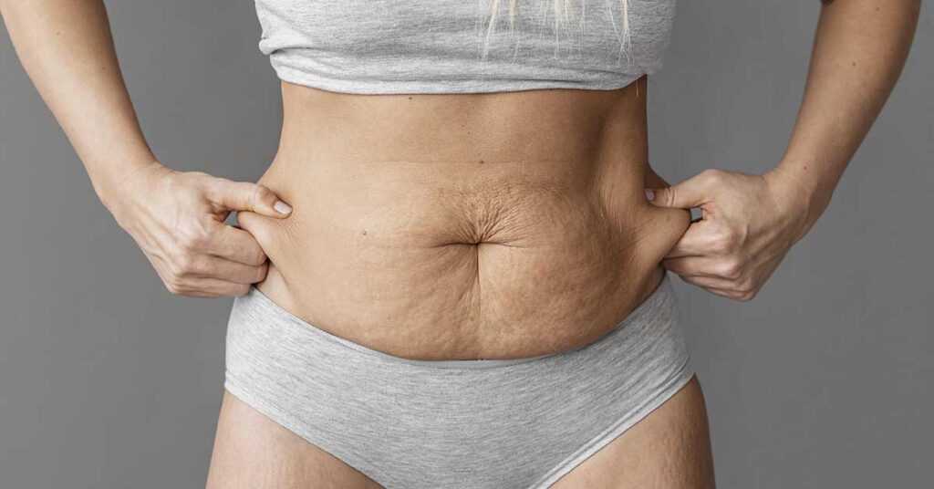 Abdominoplastia para perda de peso extrema: considerações especiais